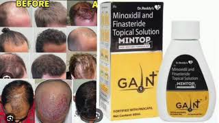 Mintop Gain  Hair Restore Formula Kit Minoxidil and Finasteride Topical Solution [upl. by Darce]