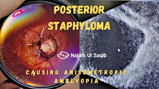 Posterior Staphyloma Causing Myopic Anisometropic Amblyopia [upl. by Dranreb962]