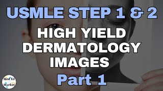 High Yield Dermatology Images  USMLEStep 1Step 2COMLEX part 1 [upl. by Buckden]