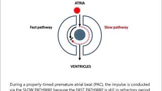 AV Nodal Reentry Tachycardia AVNRT for noncardiologist in less than 2 minutes [upl. by Domingo]