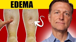 8 Surprising Causes of Edema Uncover the Truth [upl. by Naitsirc388]