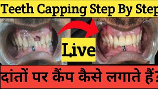 Teeth Capping Process Step By Step दांतों पर कैप कैसे लगाते हैं Zirconia Cap On Teeth Cap Cost [upl. by Arahat730]