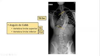 Escoliosis idiopática del adolescente Dr Juan Guevara [upl. by Limak]