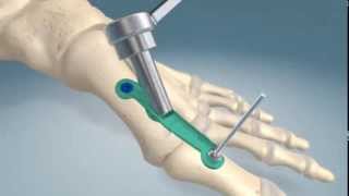 1st metatarsalphalangel joint fusion procedure [upl. by Eimmaj467]