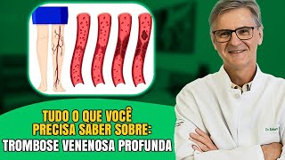 O Que é Trombose Venosa Profunda Dr Robert Wagner Explica [upl. by Ajroj]