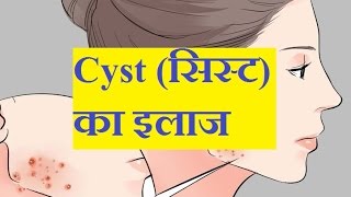 कैसे सिस्ट से छुटकारा पायें  Cyst Treatment ।। 100 Benefits By Sahajyog [upl. by Methuselah610]