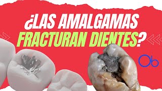 ¿Las Amalgamas causan fracturas en los dientes 🦷 [upl. by Ial]