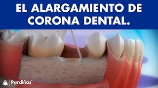 Alargamiento de corona dental © [upl. by Tiloine]