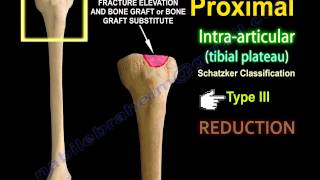 Tibial Plateau Fracture Fixation Proximal Tibia  Everything You Need To Know  Dr Nabil Ebraheim [upl. by Llewellyn]