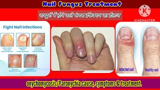 उंगली में सूजनदर्दहोने के कारण व ईलाजparonychianail fungus symptoms amp treatmenthindi [upl. by Elrebma]