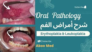 Erythroplakia amp leukoplakia 1 pathology amp systemic diseases related to oral pathology شرح أمراض الفم [upl. by Garcia981]