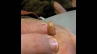 Man Squeezes Botfly from Hand [upl. by Dominy]