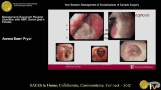 Marginal ulcers amp GGF after RYGB [upl. by Arlynne]