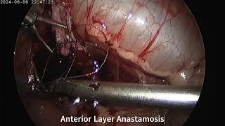 Laparoscopic Pyeloplasty in an Infant [upl. by Saito940]