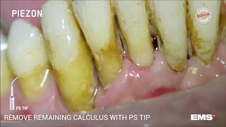 Dentální hygiena  EMS ultrazvuk [upl. by Drobman]