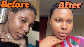 How I cleared my acne using 2 products My acne journey [upl. by Leid131]