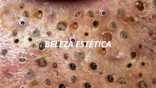 COMO REMOVER CRAVOS E ESPINHAS DO ROSTO COM AGULHA 13 [upl. by Beitz723]