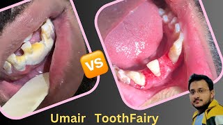 Calculus effect on gumstreatment Scaling  dentaldentistrysmileumairtoothfairyUmairazeem8553 [upl. by Akissej]