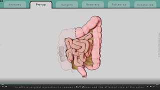 Right Hemicolectomy explained  What patients can expect  TVASurg [upl. by Fryd]