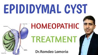 Epididymal cyst smptoms causes and treatment  Epididymal Cyst Treatment Homeopathic  in Hindi [upl. by Gaal]