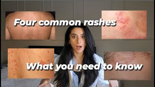 Four common rashes and everything you need to know about them [upl. by Yednarb916]