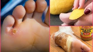 Remove the foot thick calluses and corns [upl. by Joy]