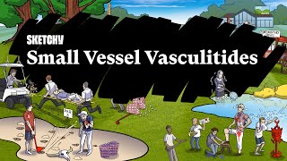 Small Vessel Vasculitides Part 1  Pathophysiology  Sketchy Medical  USMLE Step 1 [upl. by Rosmarin343]