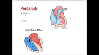 Pentalogy of fallot  Dr Akif Baig [upl. by Eanaj]