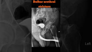 RGU  Retrograde urethrogram  Bulbar urethral stricture shorts rgu radiology specialcase [upl. by Servais921]