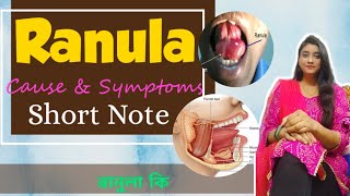 Ranula কী  plunging ranula  mucocele  treatment of RANULA  Etiology Clinical Features [upl. by Acirre70]