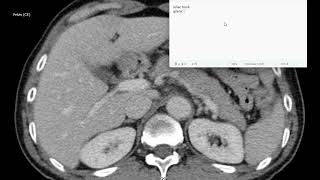 celiac trunk anatomy in CT scan [upl. by Ailema]