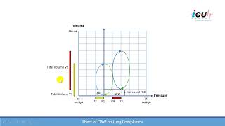 The Effects of CPAP on Lung Compliance [upl. by Tymes]