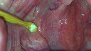 Tonsil Stone Removal Using Wooden Tool [upl. by Annahaj]