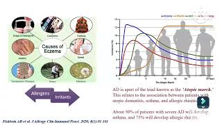 Atopic dermatitis diagnosis amp assessment Prof Ghada Shousha Pediatric immunology amp allergy Ain Shams [upl. by Aitas]