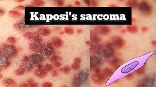 Kaposis sarcoma pathology  Kaposis sarcoma lecture  Quick revision  tarangacademy7561 [upl. by Dyrrej]