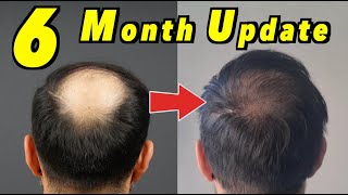 6 Month 2nd Hair Transplant Update  4000 GRAFTS FUE  CROWN UPDATE [upl. by Weaks784]