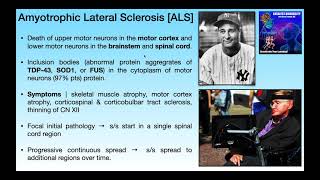 Amyotrophic Lateral Sclerosis ALS  Basics amp Clinical Presentation [upl. by Beverley]