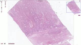 Acute Pyelonephritis  Histopathology [upl. by Namsaj851]