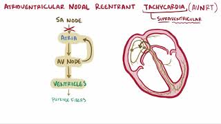 Atrioventricular reentrant tachycardia AVRT amp nodal reentrant tachycardia AVNRT [upl. by Aslin]