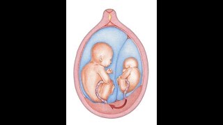 Monochorionic Twin Pregnancy [upl. by Ervine]