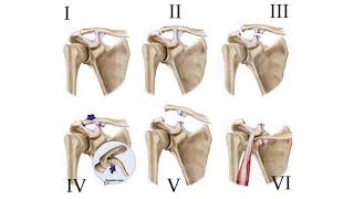 LESIONES DE LA ARTICULACIÓN ACROMIOCLAVICULAR [upl. by Ric]