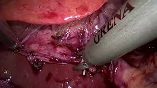 Laparoscopic Cholecystectomy 24 anam [upl. by Aisauqal]