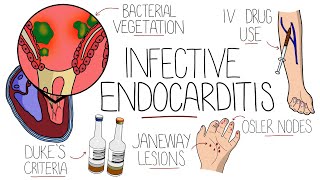 Infective Endocarditis With Duke Criteria amp Pathophysiology [upl. by Madian554]