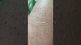 How to get rid of ingrown hair keratosis pilaris strawberry skin at home dermatologist skincare [upl. by Scuram590]