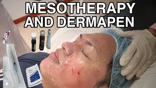 MESOTHERAPY AND DERMAPEN MICRONEEDLING  FIRST SESSION [upl. by Aneehs48]