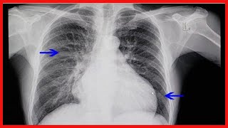 ¿Qué es la cardiomegalia y por qué ocurre [upl. by Christean]