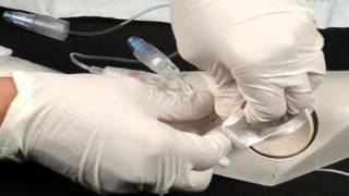 Chapter 8  PICC Catheter Removal [upl. by Karole]