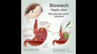 Peptic Ulcer Disease [upl. by Moule946]