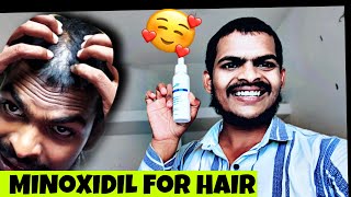 I BOUGHT MINOXIDIL FOR HAIR REGROWTH 🙂😥 [upl. by Salahi77]