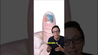 Hematoma Subungueal 💅😱 medicina medico curiosidades saude enfermeira enfermagem saúde [upl. by Fradin]